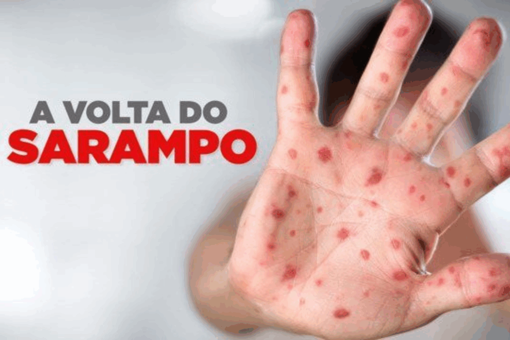 EMERGÊNCIA: Sarampo Avança na Bolívia e Acre Reforça Vacinação na Fronteira Notícias do Acre e6Barra8