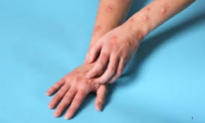 ALERTA: Rio Branco Registra Caso Suspeito de Mpox; Paciente está em Isolamento e Resultado Sai até Quarta-Feira