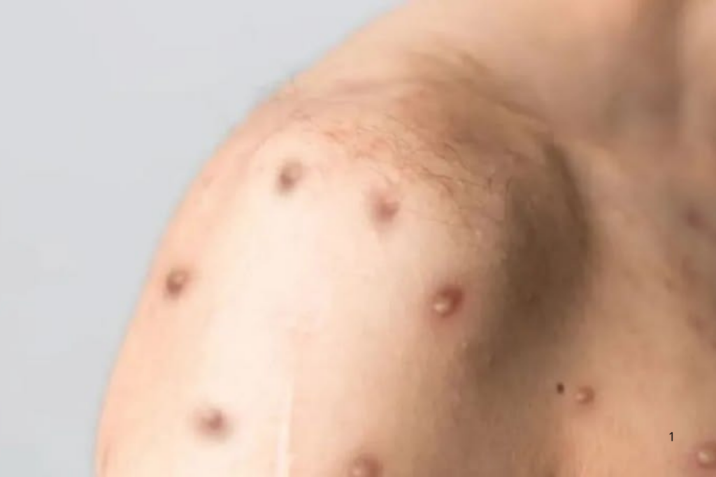 Mpox: Acre Registra Primeiro Caso em 2026 e Acende Alerta para Vigilância em Saúde