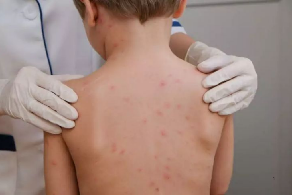 ALERTA: O Dia Mundial de Combate à Meningite no Brasil Preocupa com a Baixa Vacinação e Novos Sorotipos 
